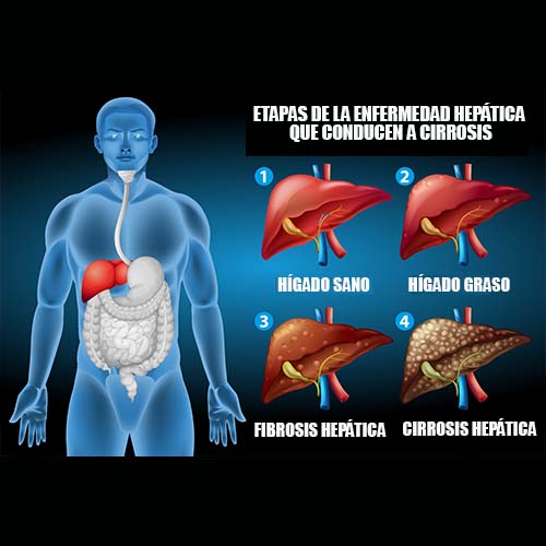 ETAPAS HIGADO ENFERMO